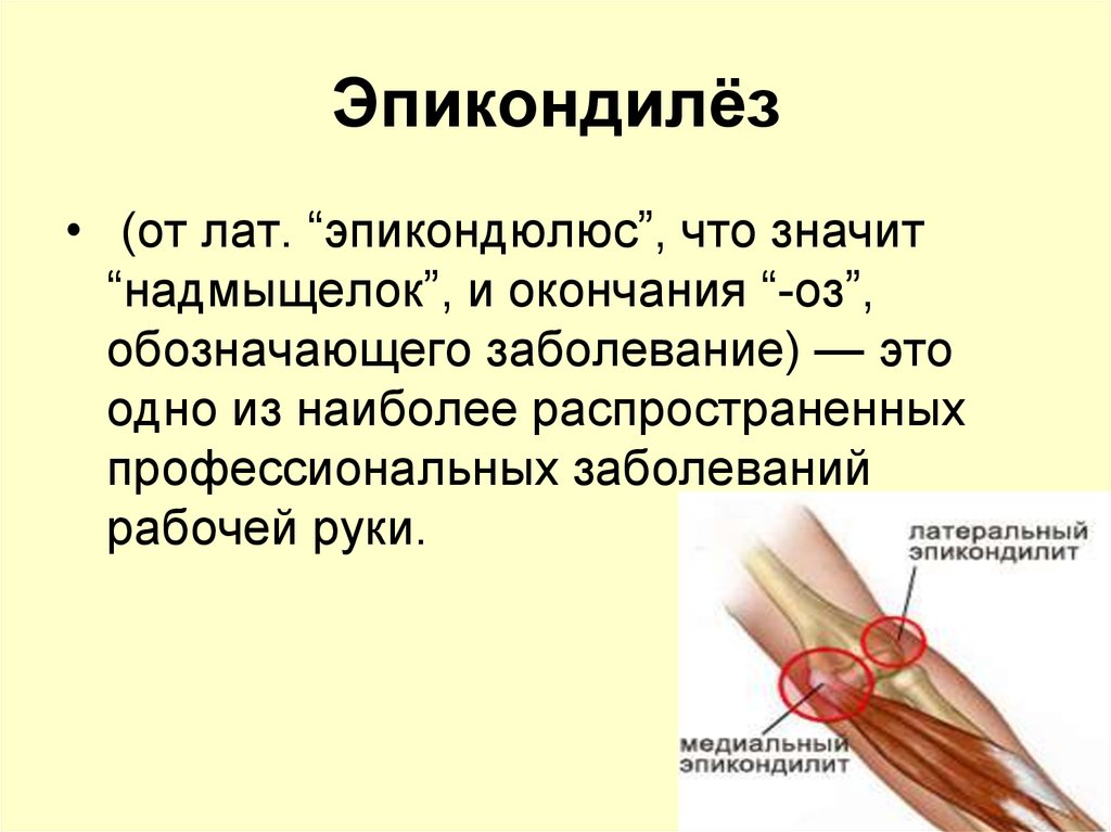 Эпикондилёз