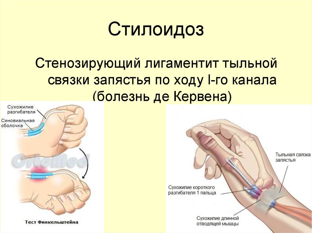 Болезнь де кервена. Болезнь де Кервена лучезапястного сустава. Болезнь Нотта и де Кервена. Лигаментит лучезапястного сустава. Болезнь де Кервена клиника симптомы.