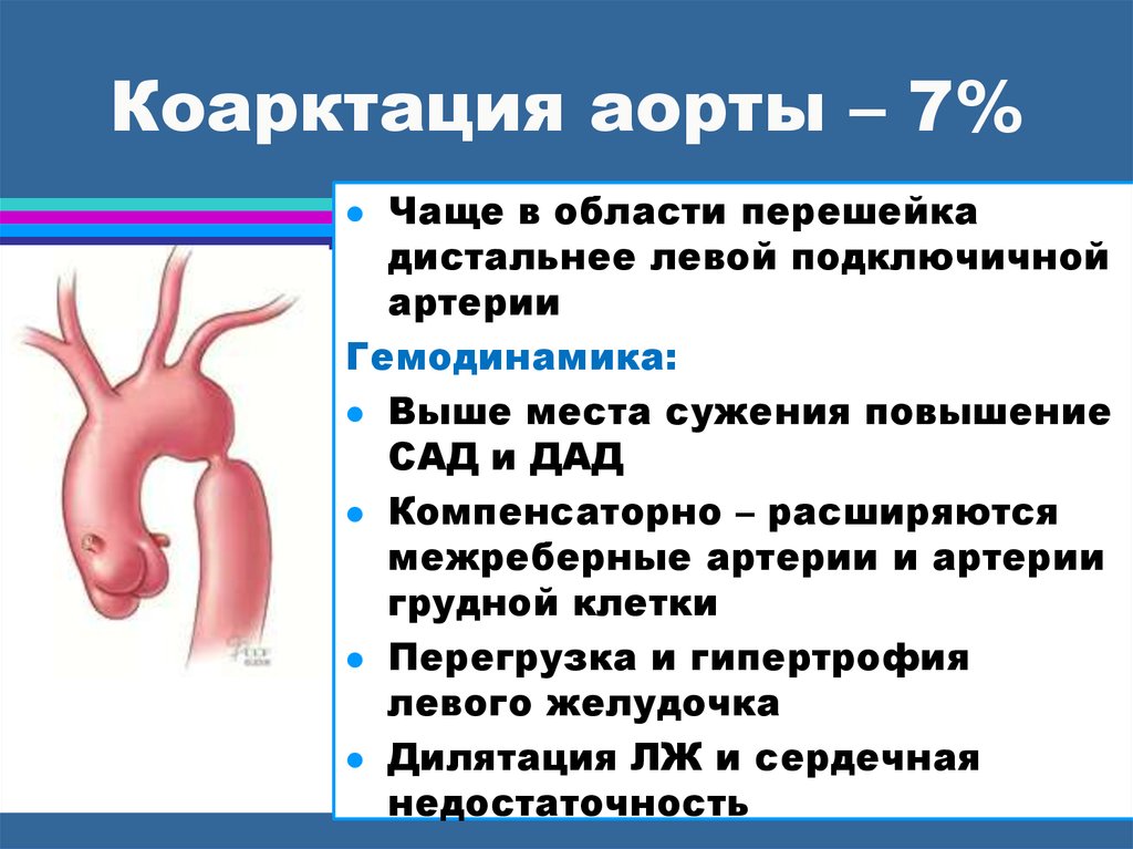 Коарктация аорты презентация