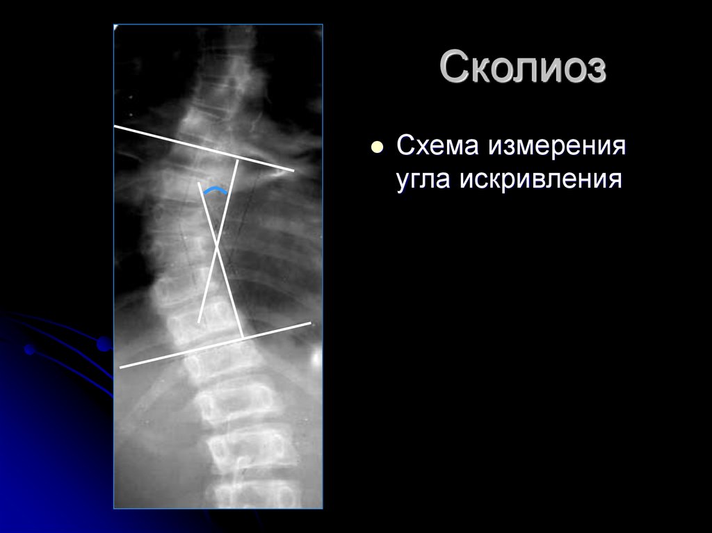 Сколиоз 3 степени фото рентген