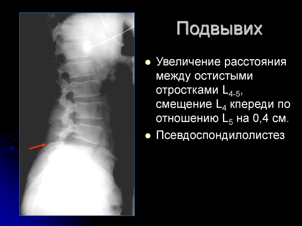 Подвывих позвонка. Смещение остистого отростка. Смещение остистых отростков позвоночника. Сублюксация позвонков это. Подвывих l5.