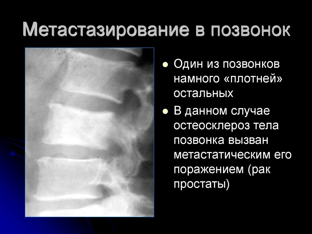 Очаговые изменения костей. Метастаз в позвонке рентген. Метастазы в позвоночнике рентген. Опухоль позвоночника рентген. Метастазы в позвоночнике рентгенограмма.