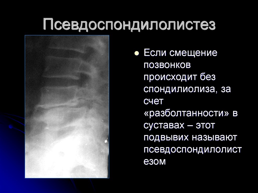 Как лечить смещение позвонков. Псевдоспондилолистез. Спондилолистез о отдела позвоночника. Диагноз смещение позвонков. Псевдоспондилолистез шейного отдела позвоночника.