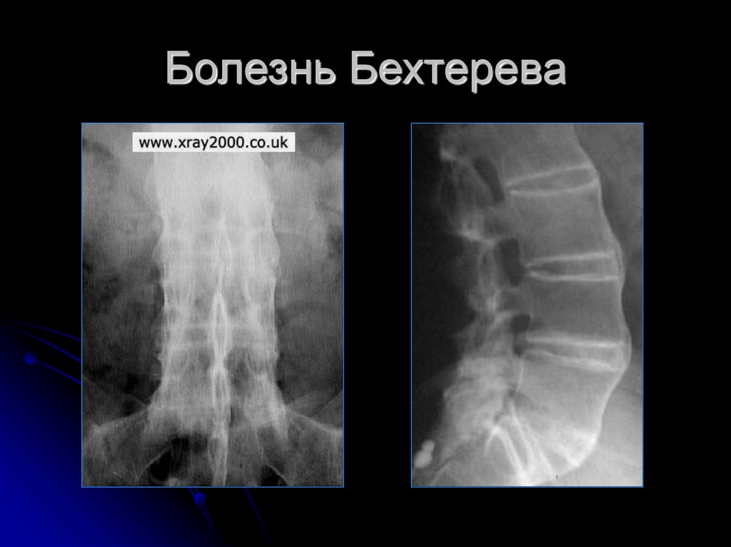 Болезнь бехтерева презентация госпитальная терапия