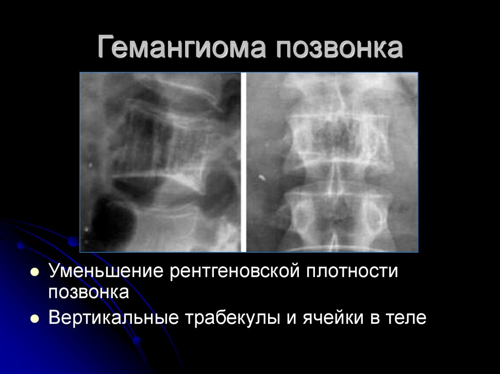 Гемангиолипома в теле позвонка что это такое