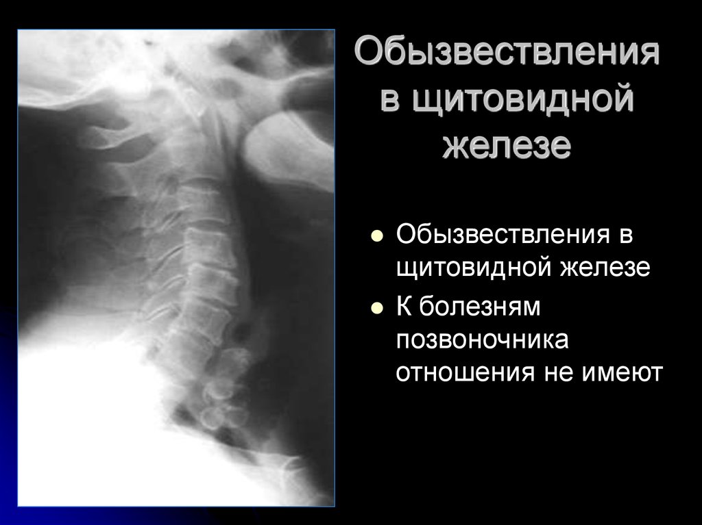 Обызвествление. Обызвествление щитовидной железы. Обызвествление щитовидной железы рентген. Обызвествление хряща щитовидной железы. Обызвествление позвоночника.