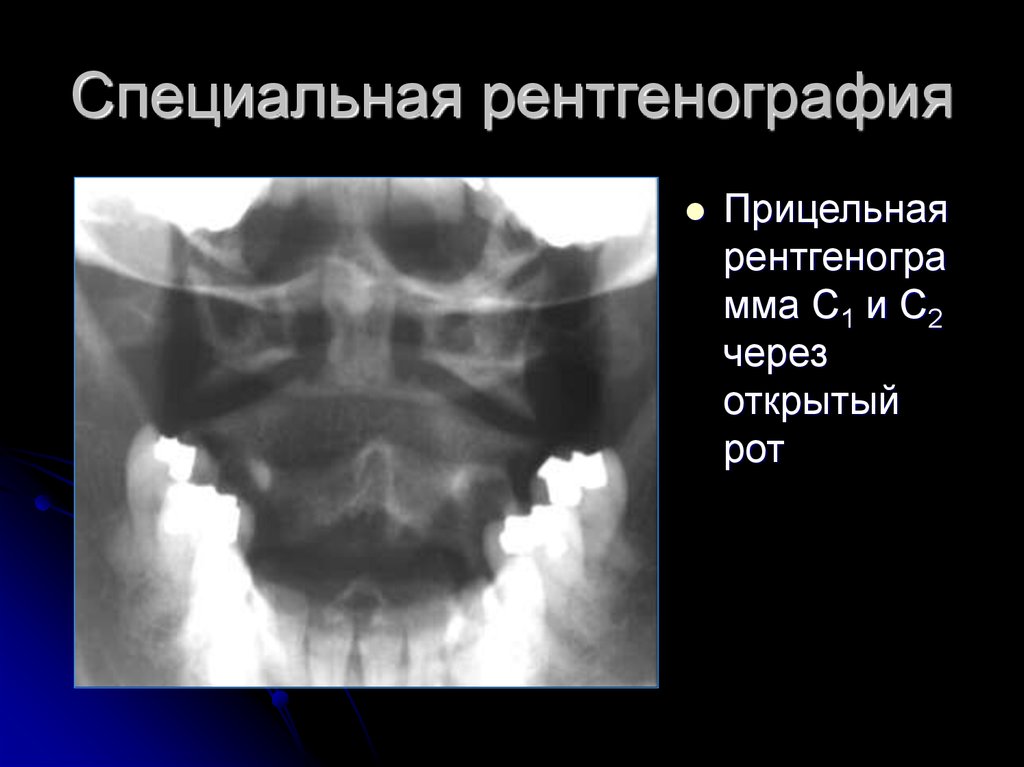 Рентгена 2. Подвывих Атланта рентген описание. Рентгенография шейных позвонков (с1, с2) трансорально.