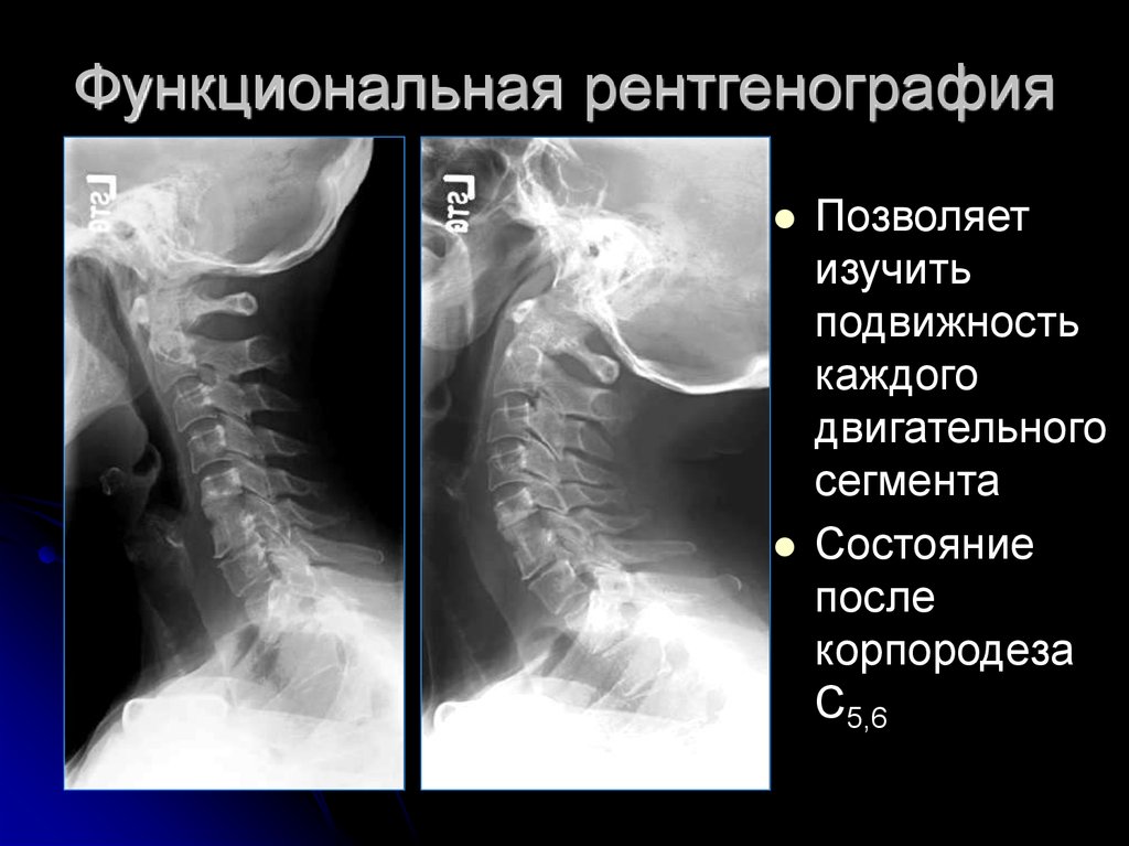 Остеохондроз на рентгене фото