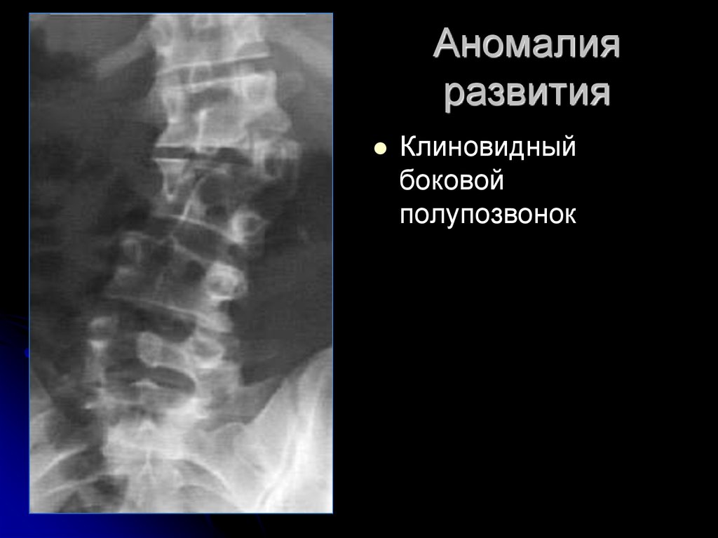 Клиновидные позвонки. Полупозвонок аномалия. Клиновидная деформация позвонков грудного отдела рентген. Аномалии развития позвоночника рентген. Боковая клиновидная деформация тела позвонка рентген.