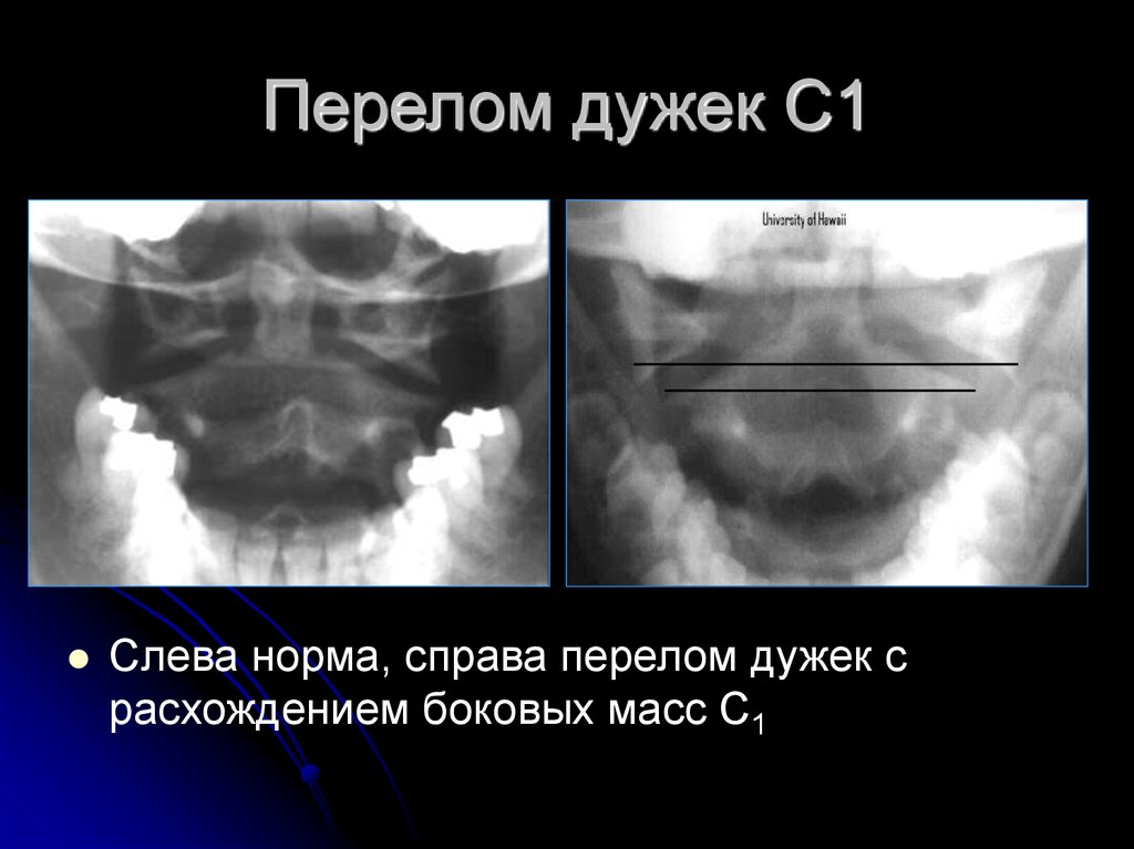 Перелом справа. Перелом боковых масс s1. Перелом боковой массы с1.