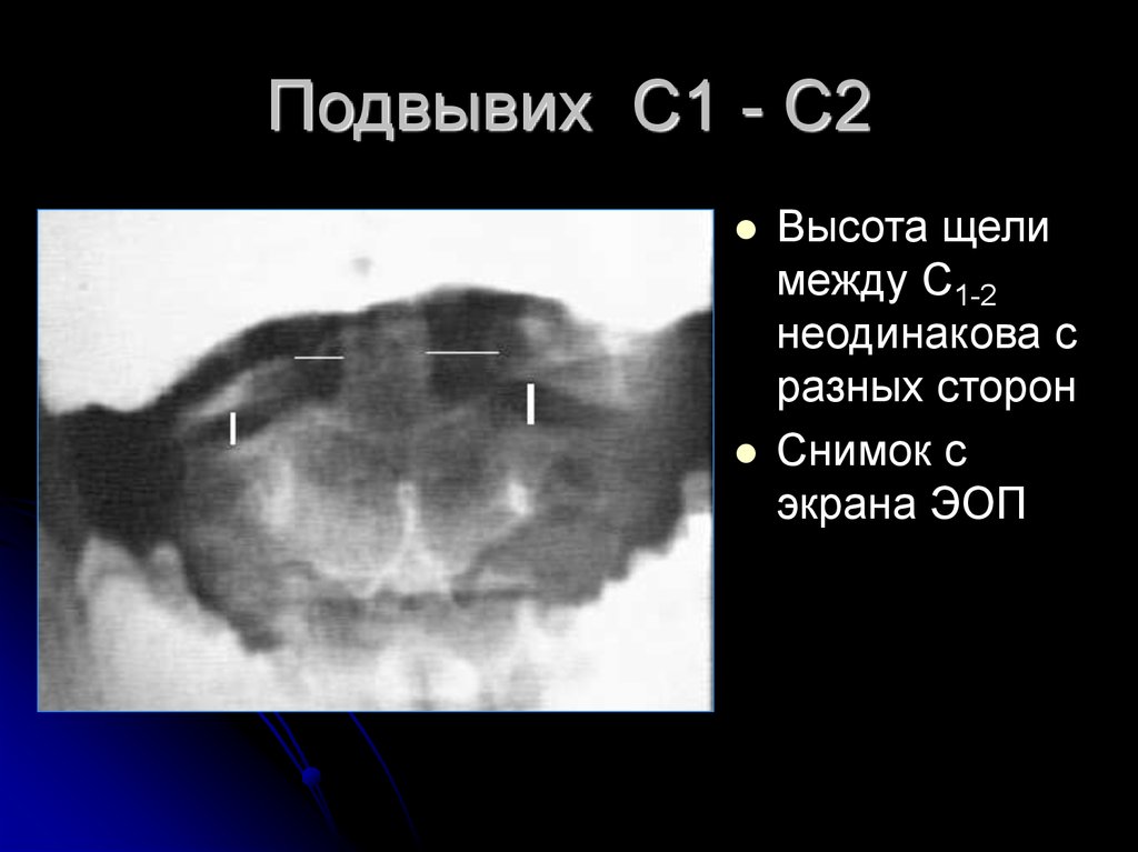 Ротационный подвывих. Ротационный подвывих Атланта с1. Рентген ротационный подвывих с1 с2. Ротационный подвывих с1 позвонка на рентгене. Подвывих с1 позвонка рентген.