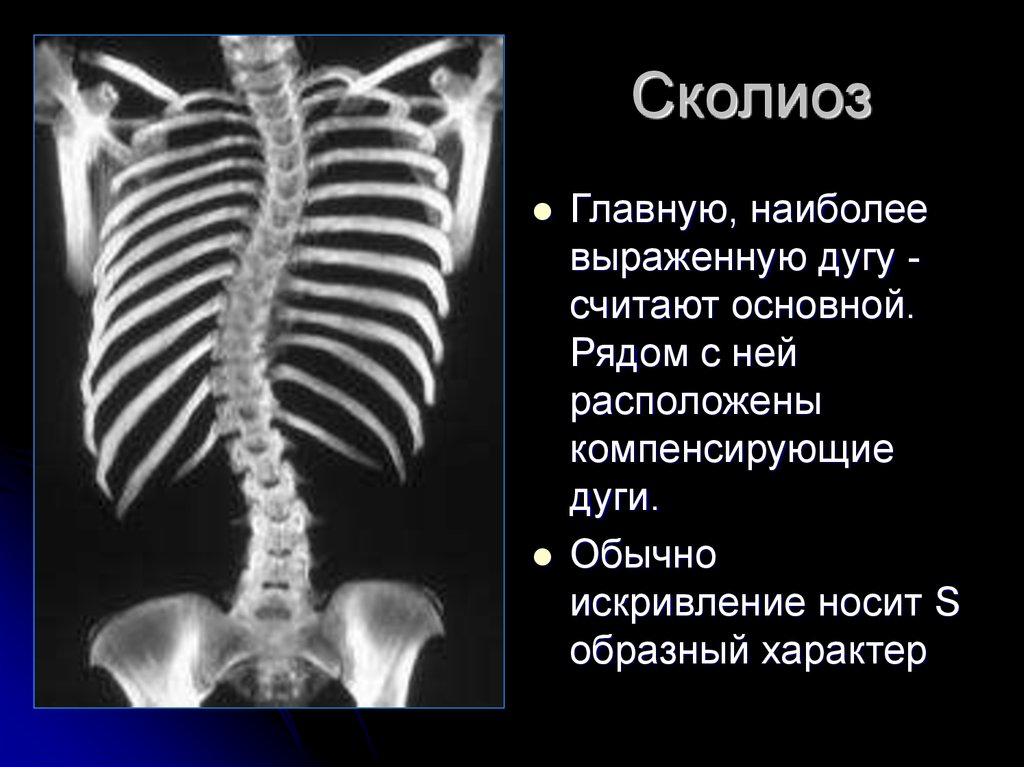 Стадии сколиоза позвоночника фото