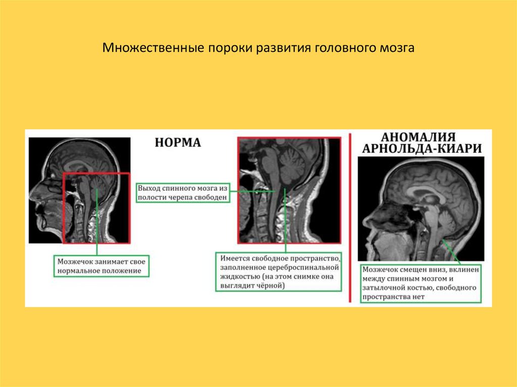 Синдром арнольда киари презентация