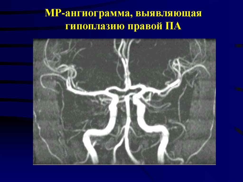Гипоплазия правой артерии мозга. Гипоплазия позвоночной артерии. Гипоплазия почечной артерии.