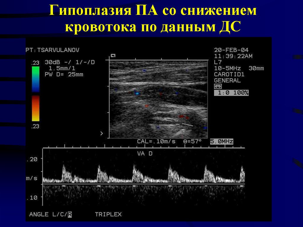 Гипоплазия сегмента v4 позвоночных артерий. Гипоплазия позвоночной артерии УЗДГ. Гипоплазия позвоночной артерии на УЗИ. Стил синдром подключичной артерии на УЗИ.