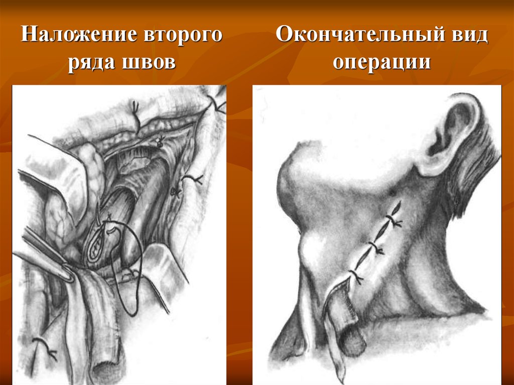 Операции на пищеводе. Шов пищевода двухрядный. Эзофаготомия пищевода топографическая анатомия. Эзофагостома операция.