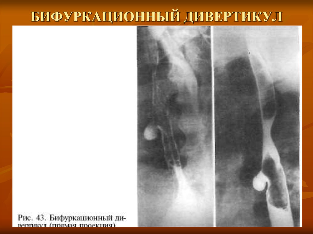 Презентация дивертикул пищевода