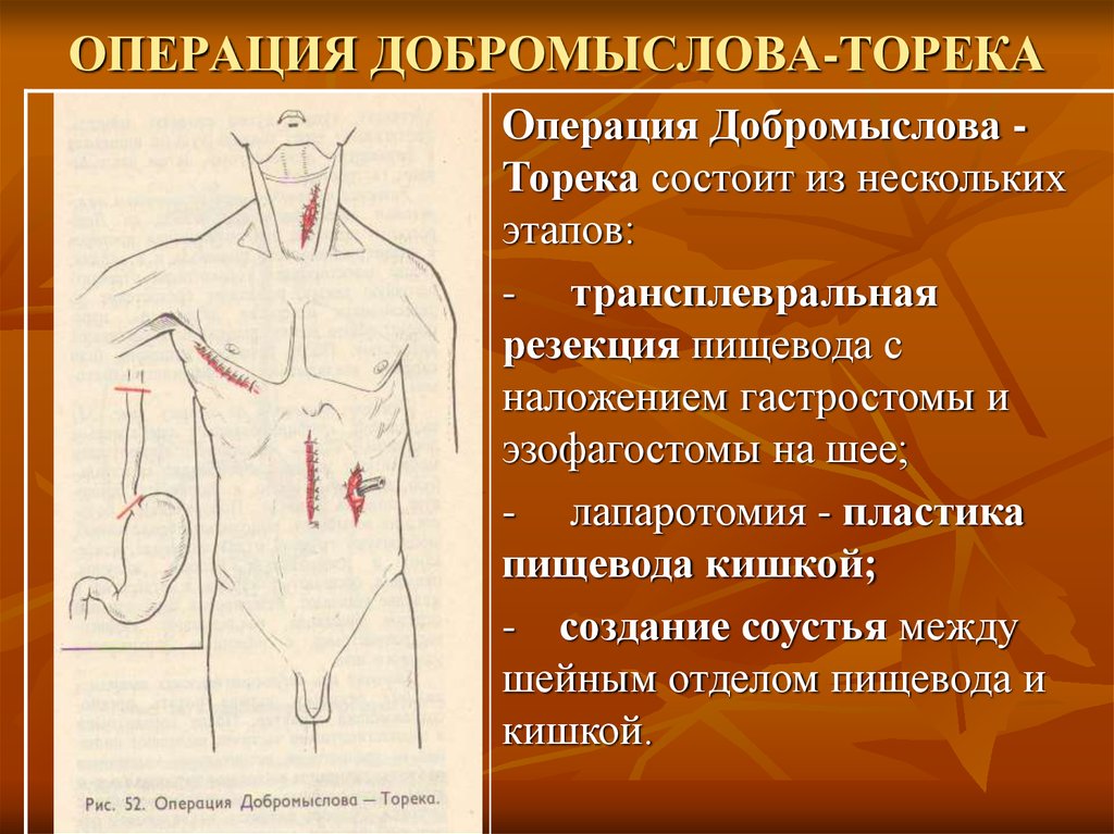 Операция герлока схема