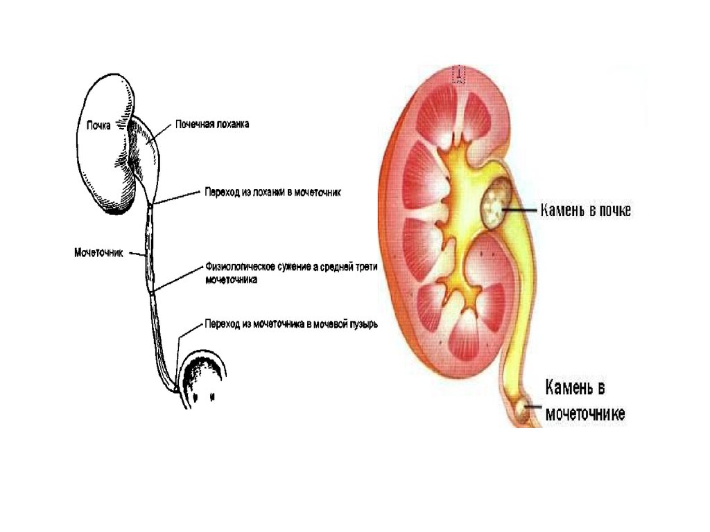Нижняя треть почки. Почечная лоханка колика. Почечно-каменная болезнь почечная колика. Камень в лоханке почки схема. Камень юкставезикального отдела мочеточника.