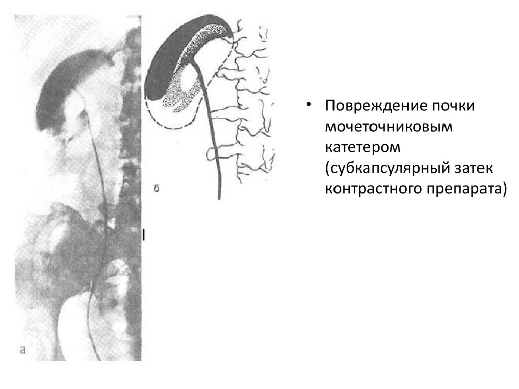 Травмы почек презентация