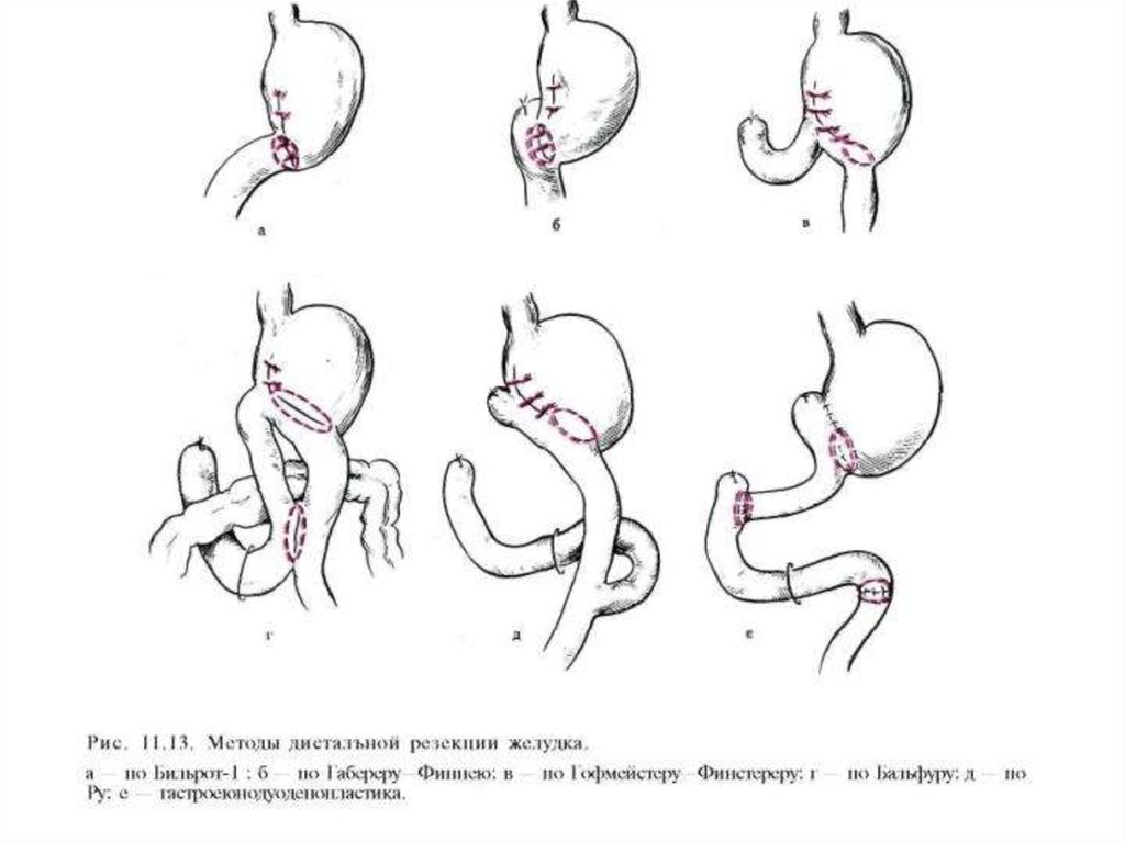 Резекция желудка схема