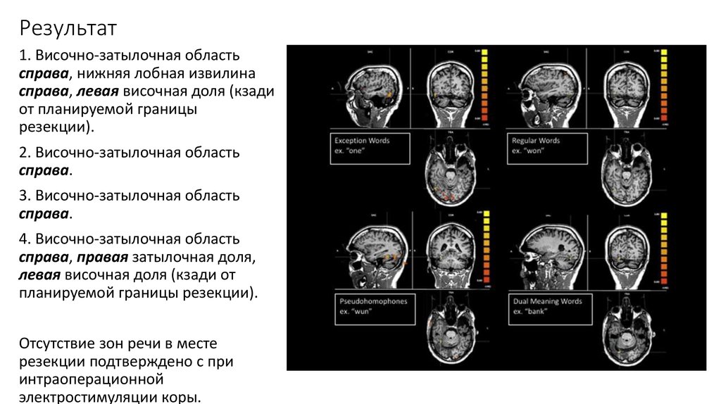 Левая височная. Левая височная область. Выпускник на кт в затылочной кости. Выпускник на кт в области затылочного бугра.