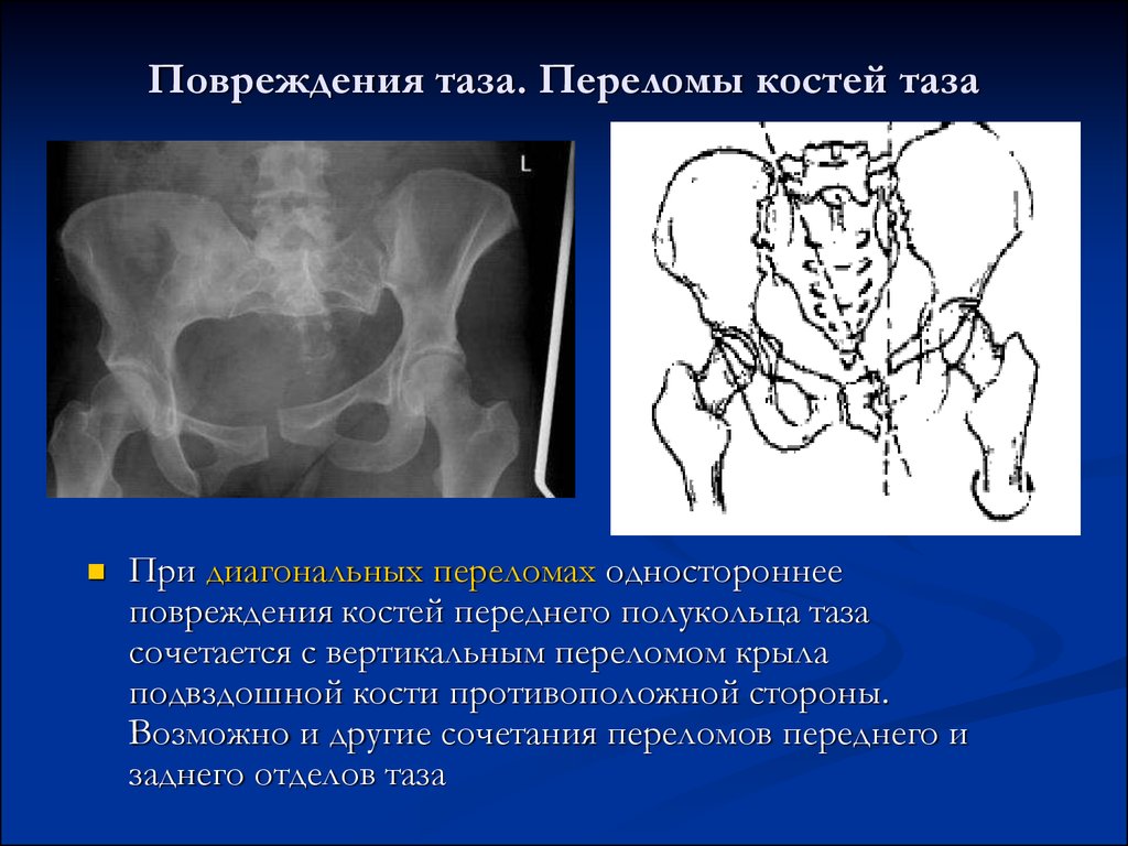 Односторонний разрыв. Перелом тазовой кости рентген. Трещина лонной кости рентген. Перелом костей таза рентгенограмма. Перелом подвздошной кости.
