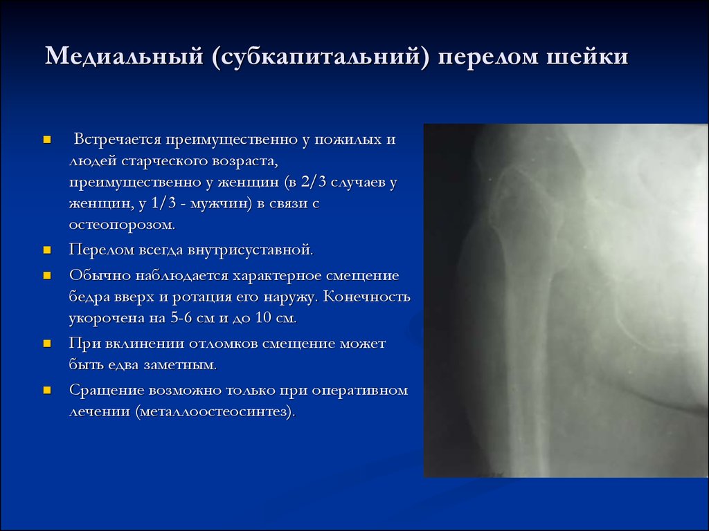 Карта вызова смп перелом шейки бедра справа