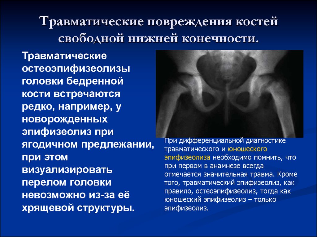 Травматические повреждения костей свободной нижней конечности.
