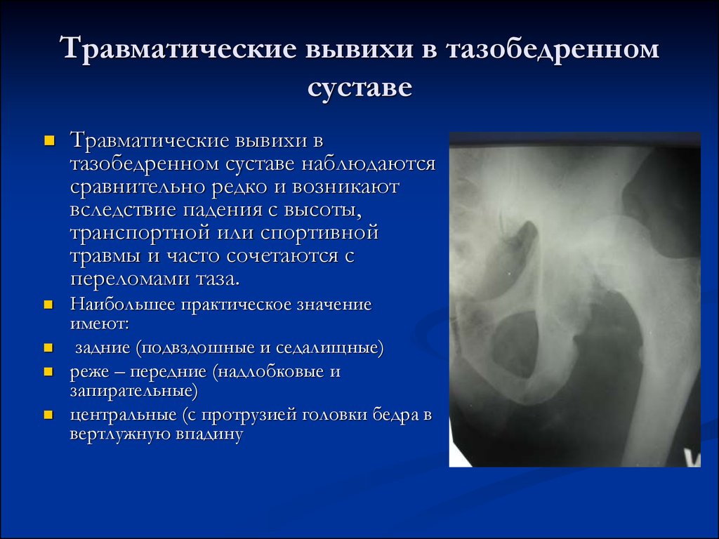 Вывих тазобедренного сустава у взрослых симптомы. Вывих тазобедренного сустава. Травматические вывихи бедра: классификация. Травматические вывихи в тазобедренном суставе.