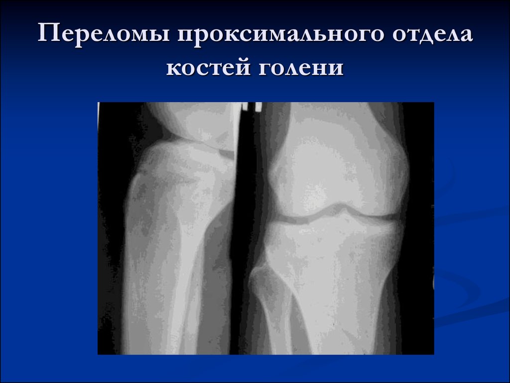 Проксимальный отдел кости. Перелом проксимального отдела большеберцовой кости. Перелом проксимального метадиафиза большеберцовой кости. Проксимальный перелом голени. Переломы большеберцовой кости классификация рентген.