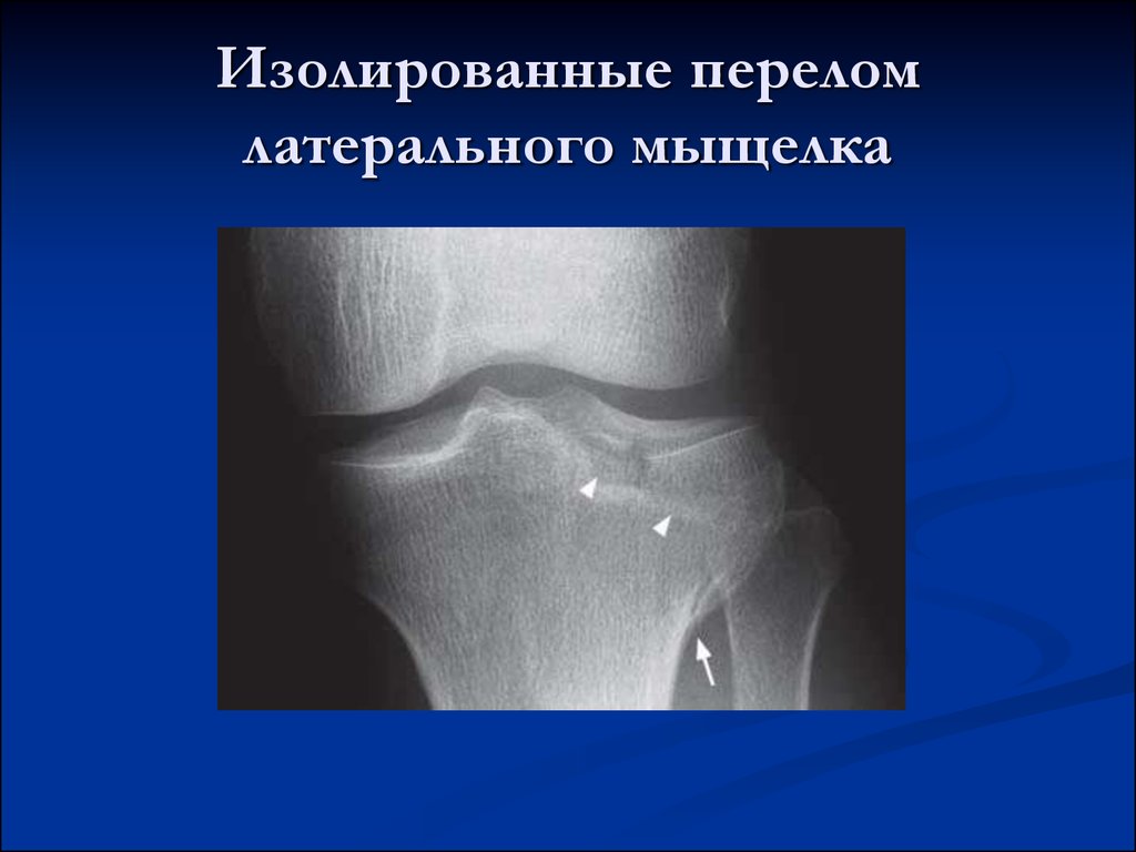 Мыщелка берцовой. Импрессионный перелом коленного сустава. Перелом наружного мыщелка большеберцовой кости рентген. Перелом мыщелка коленного сустава рентген. Компрессионный перелом наружного мыщелка большеберцовой кости.
