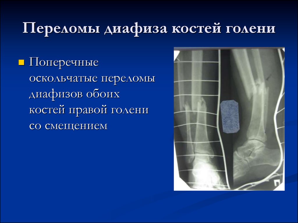 Переломы костей голени тест нмо