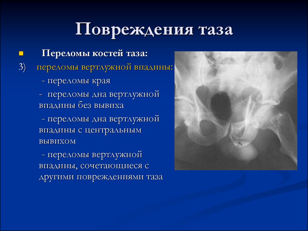 Переломы таза травматология презентация