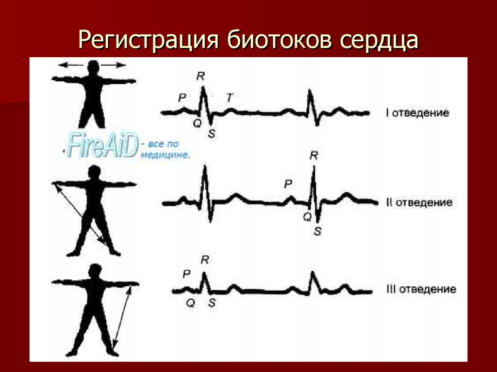 Картинка стандартные отведения