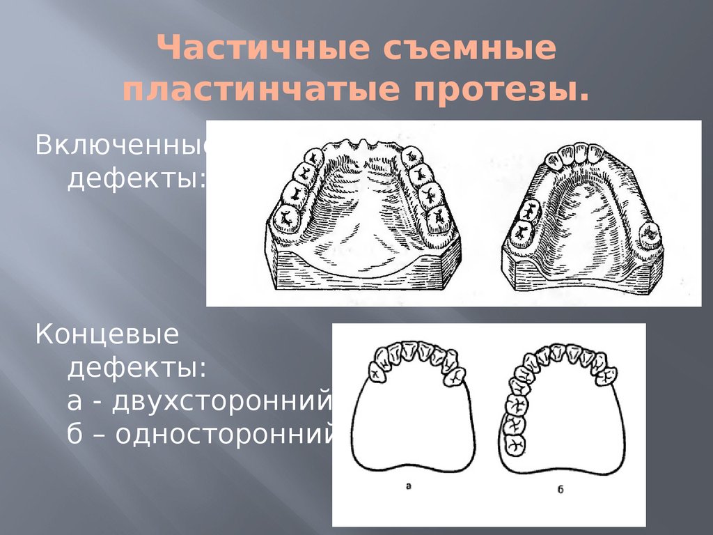 Технология съемных протезов. Односторонний концевой дефект зубного ряда. Концевые дефекты зубных. Методы фиксации частичных съемных пластиночных протезов.