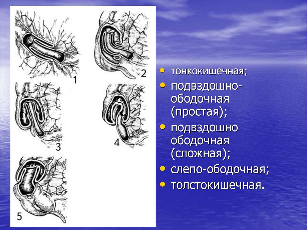 Инвагинация кишечника. Подвздошно ободочная инвагинация. Илеоцекальная подвздошно ободочная инвагинация. Подвздошно-ободочная инвагинация кт. Инвагинация кишки классификация.