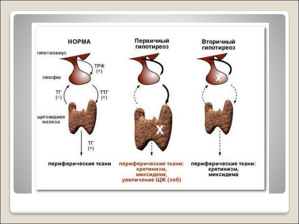 Гипотиреоз причины. Врожденный гипотиреоз патогенез схема. Гипотиреоз первичный вторичный третичный. Врожденный гипотиреоз патогенез. Этиология вторичного гипотиреоза.
