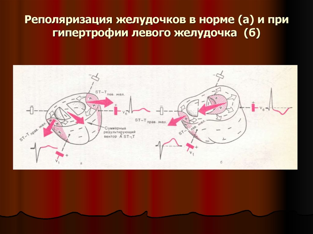 Изменение реполяризации левого желудочка. Реполяризация миокарда желудочков. Распализация желудочков. Реполяризация желудочков норма. Реполяризация миокарда левого желудочка что это такое.