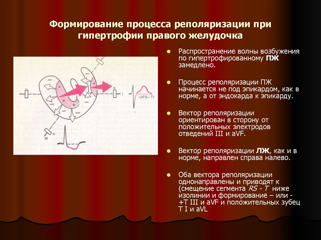 Диффузные нарушения процессов. Нарушение реполяризации миокарда левого желудочка на ЭКГ. Реполяризация при гипертрофии левого желудочка. Нарушение процессов реполяризации. Изменения процессов реполяризации.