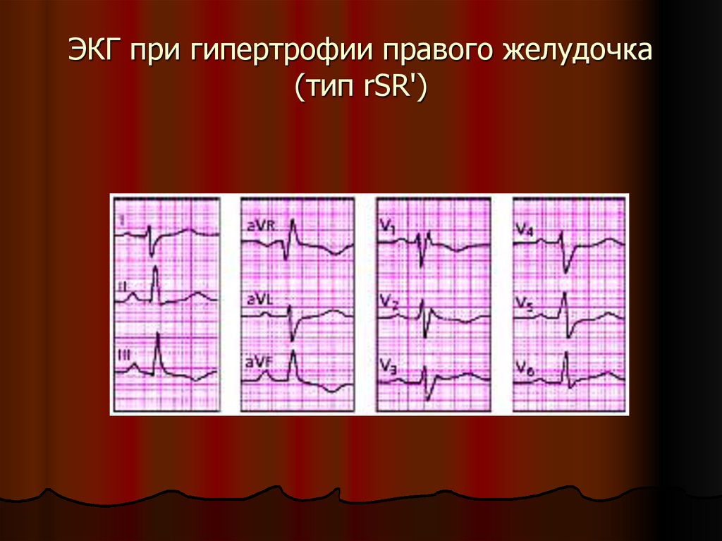 Гипертрофия левого желудочка что это. S Тип гипертрофии правого желудочка. ЭКГ при гипертрофии правого желудочка s Тип. Гипертрофия правого желудочка на ЭКГ RSR Тип. Гипертрофия правого желудочка r Тип на ЭКГ.