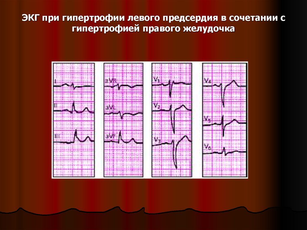 Гипертрофия левого предсердия на экг. Гипертрофия правого желудочка и левого предсердия ЭКГ.