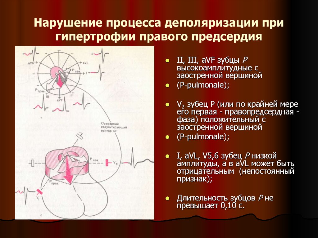 Нарушение процессов. Процесс деполяризации. Нарушение деполяризации. Процессы деполяризации на ЭКГ. Нарушение правого предсердия что это.