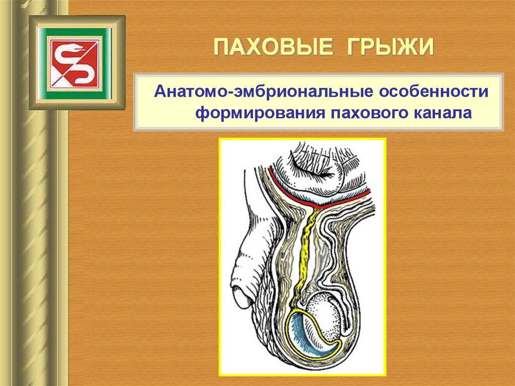 Паховая грыжа у мужчин где находится картинка