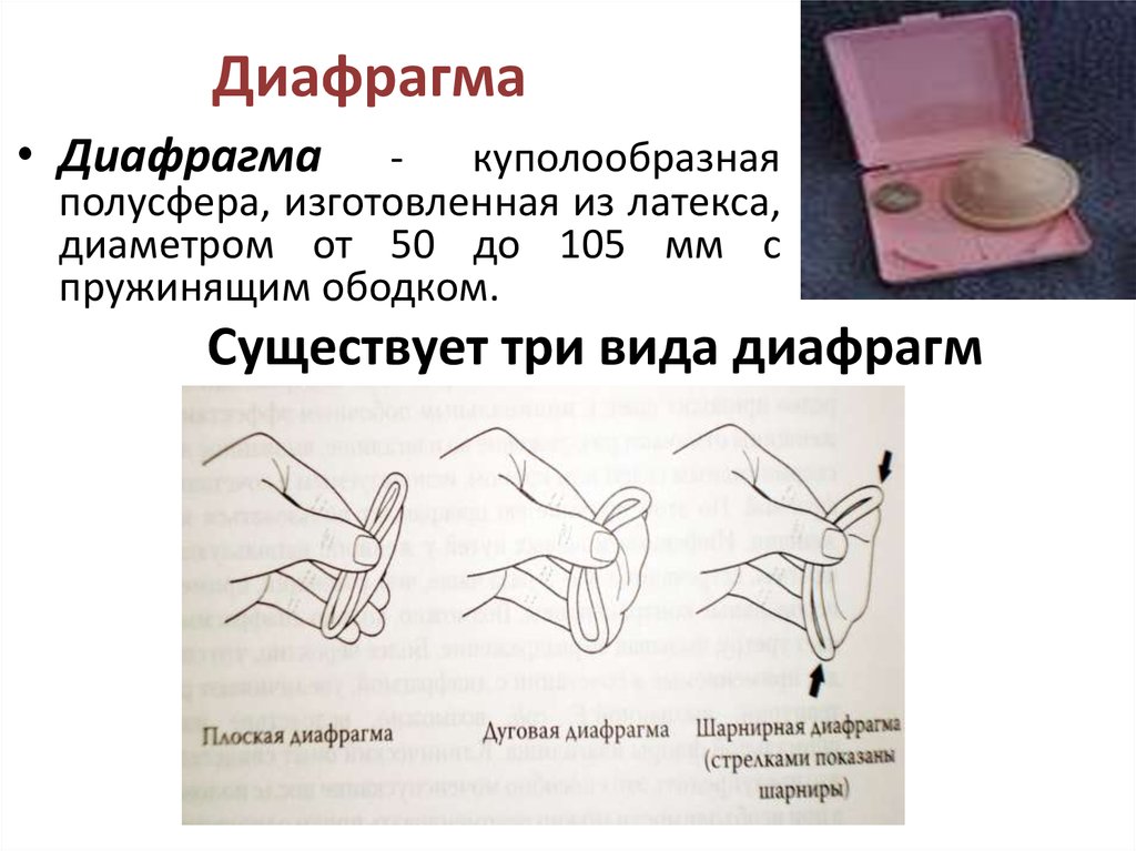 Методы контрацепции