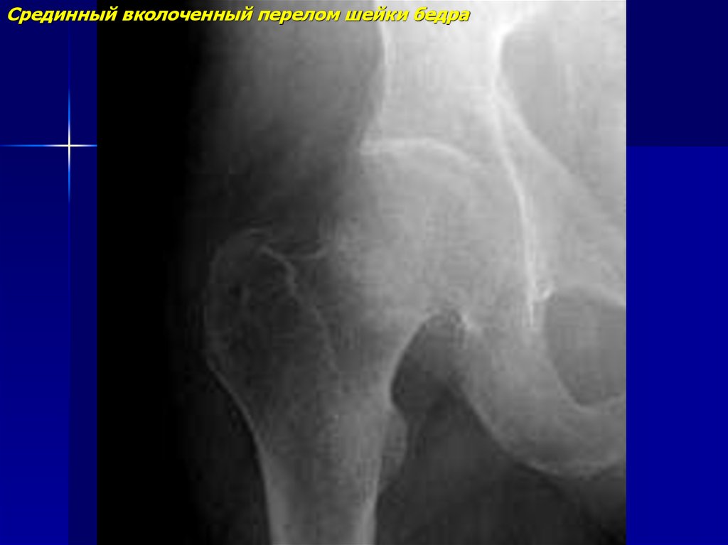Вколоченный перелом шейки бедра. Вколоченный перелом тазобедренного сустава. Вколоченный перелом шейки бедра рентген. Шейка бедра перелом вколоченный.