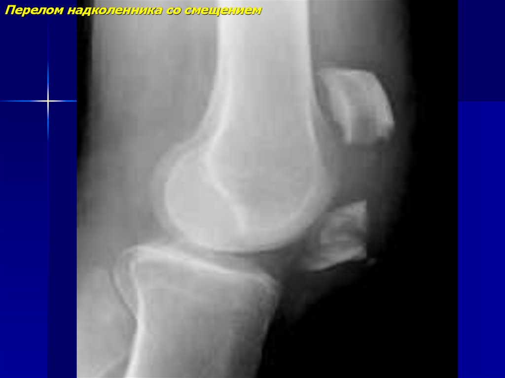 Перелом надколенника. Надколенник рентген норма. Краевой перелом надколенника без смещения.