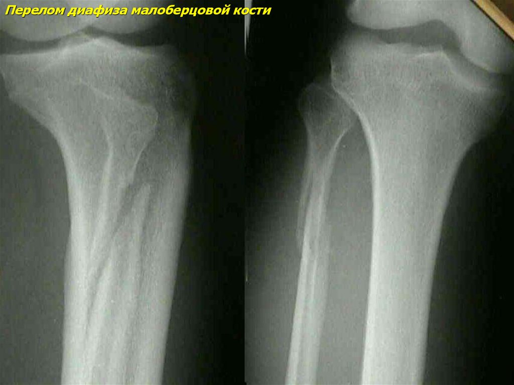 Перелом малоберцовой кости. Изолированные переломы диафиза малоберцовой кости. Перелом метаэпифиза малоберцовой кости. Перелом метафиза большеберцовой кости рентген. Субкапитальный перелом малоберцовой кости.