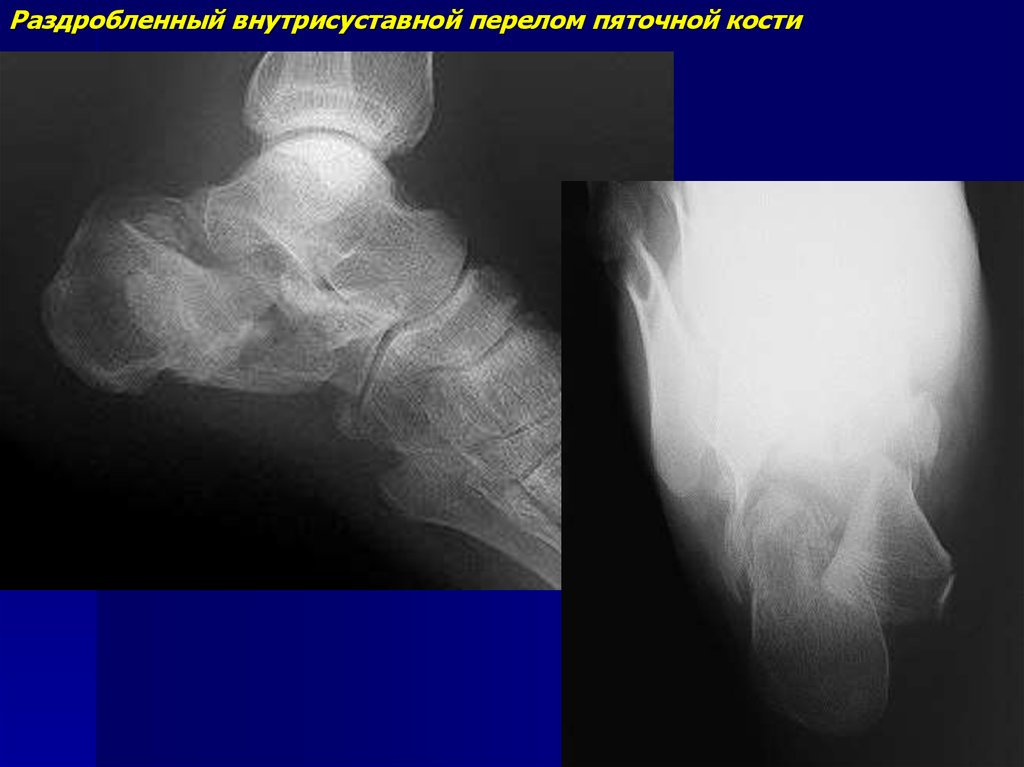 Внутрисуставной перелом. Внесуставной перелом пяточной кости. Внутрисуставной перелом пяточной кости. Перелом пяточной кости рентген. Внутрисуставной перелом пяточной кости рентген.