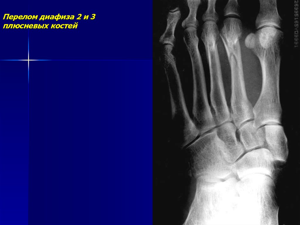 Перелом 2 плюсневой кости. Перелом диафиза 3 плюсневой кости. Рентгенодиагностика травматических повреждений костей и суставов. Перелом диафизов плечевых костей. Перелом диафиза плюсневой кости рентген.